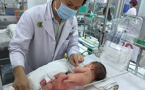 Khối u như một đứa trẻ dính vào cơ thể bé sơ sinh