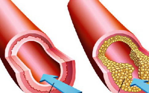 Dùng thuốc hạ mỡ máu bị nhức đầu - Vì sao?