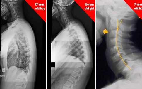 Nghiện smartphone biến trẻ em thành những 'thằng gù'