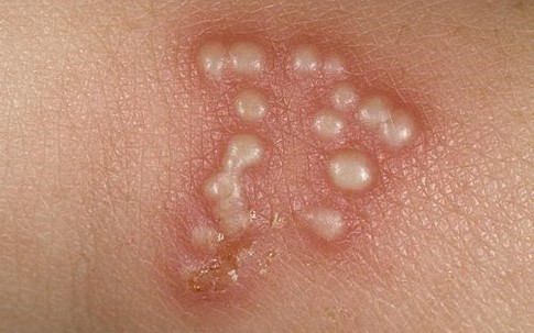 Những dấu hiệu của làn da cảnh báo bệnh tình dục nguy hiểm