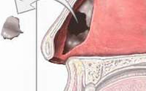 Vẹo vách ngăn mũi gây đau đầu?