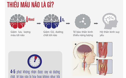 Cách điều trị thiếu máu não hiệu quả