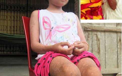 Sự thật về bé gái bị bỏng rộp toàn thân, suýt chết vì uống nước ngọt