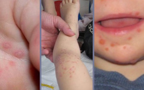 TP Hồ Chí Minh: Bệnh tay, chân, miệng khiến trẻ bị biến chứng thần kinh