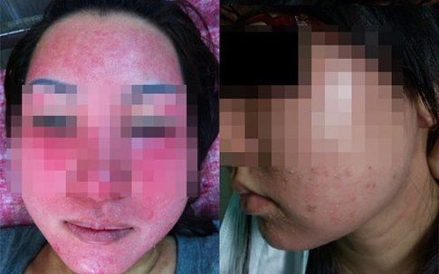 Người phụ nữ có biệt danh Bean và đơn hàng Collagen giả “khủng”