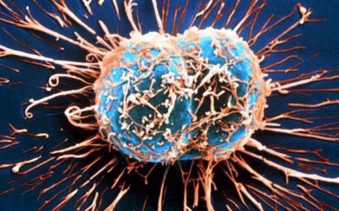 Nhật Bản tìm ra phương pháp phát hiện ung thư sau 3 phút