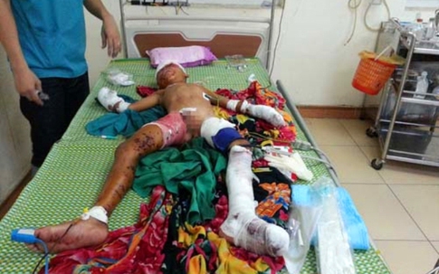 Đồ chơi phát nổ, bé trai 9 tuổi bị thương nặng