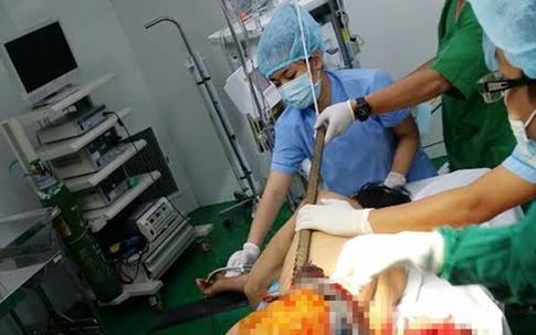 90 phút cấp cứu công nhân bị thanh sắt đâm xuyên cơ thể