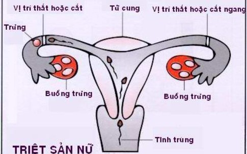 Thắt ống dẫn trứng - cách tránh thai "không có đường lui"