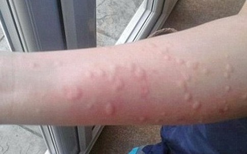 Dấu hiệu bệnh nguy hiểm từ mề đay