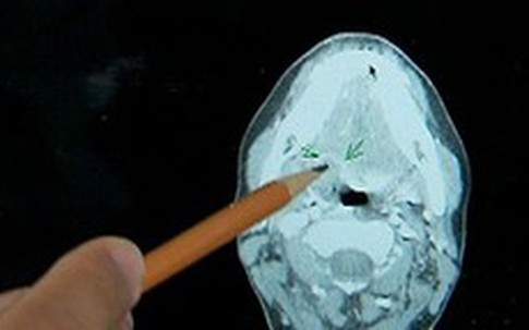 Lần đầu phát hiện một người mắc ba loại ung thư