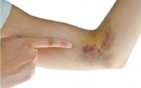 10 dấu hiệu cảnh báo bệnh ung thư máu bạn nên biết