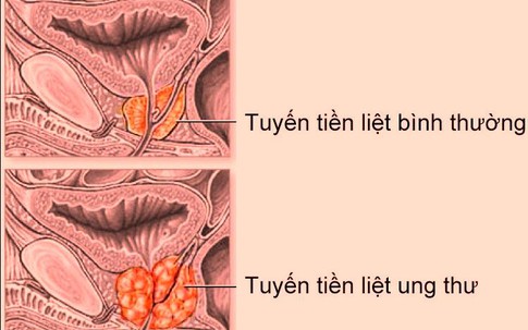 Điều trị thành công ung thư bằng phương pháp cấy hạt phóng xạ