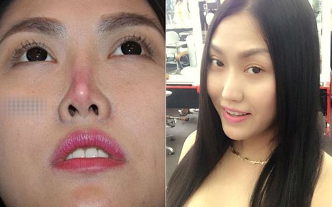 Phi Thanh Vân chia sẻ trải nghiệm hai lần làm mũi vì hết 'date'