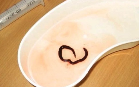 Tử vong vì giun ăn mất thận