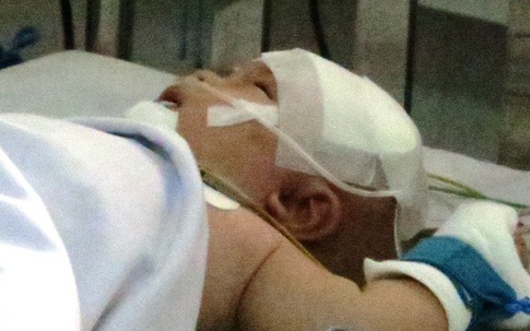 Phẫu thuật lần thứ hai, bé bị đâm xuyên sọ đã tự thở, tự bú