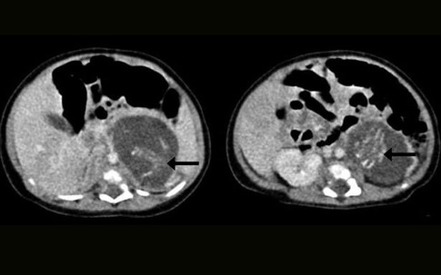 Bé gái vừa chào đời đã mang thai đôi