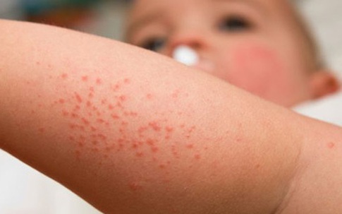 Trẻ em hay dị ứng với thực phẩm nào?