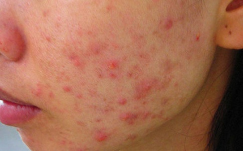Nhận biết nguy cơ nhiễm độc kim loại qua những biểu hiện trên da