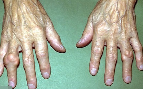 Bệnh gout và nỗi sợ hãi kinh hoàng