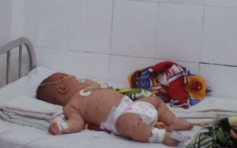 Lại thêm Bé trai 5 tháng tuổi nghi nhiễm não mô cầu