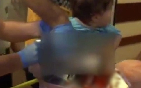 Mẹ mải nấu ăn để con trai 1 tuổi đút tay vào máy xay thịt