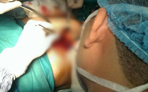 Hà Nội: Một phụ nữ bị mảnh kim loại 15cm bất ngờ cắm sâu vào ngực