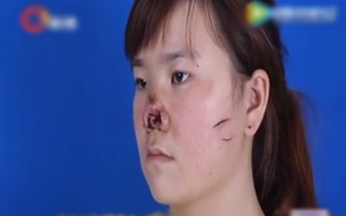 Thiếu nữ cưới chui, bị chồng cắn nát mũi
