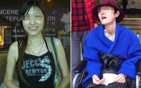 Nữ thạc sĩ xinh đẹp bị động kinh sau khi phẫu thuật thẩm mỹ gọt hàm