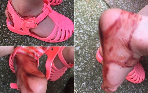 Chỉ vì đôi sandal này bé gái 2 tuổi đã phải chịu đau đớn khủng khiếp