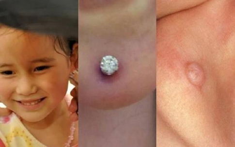 Nguy hiểm từ việc bấm lỗ tai cho con trẻ mà cha mẹ không ngờ tới