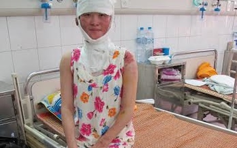 Cảnh báo gia tăng bệnh nhân bỏng do nắng nóng