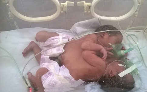 Bộ trưởng Bộ Y tế trợ giúp 10 triệu đồng cho cặp song sinh dính liền và thai phụ ung thư