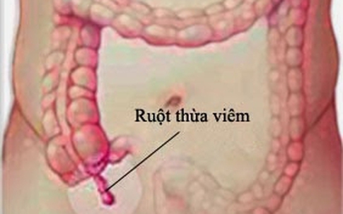 Dấu hiệu viêm ruột thừa?