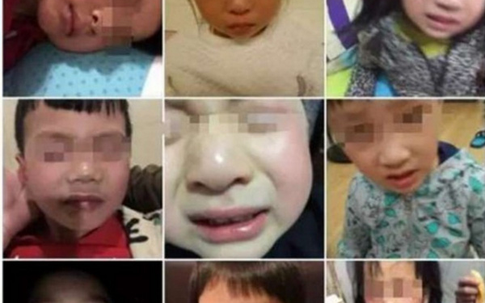 8 học sinh mẫu giáo bị bỏng mắt vì đèn cực tím diệt khuẩn