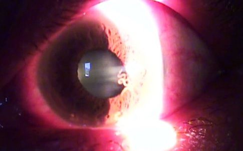 Kinh hãi Giun dài 14mm "bơi" trong mắt