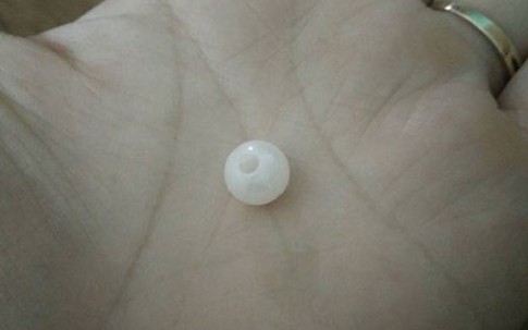 Mẹ hốt hoảng phát hiện hạt cườm trong hốc mũi con sau khi đi mẫu giáo về
