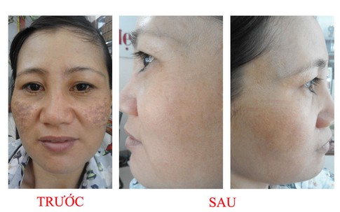 Nám có thể trị khỏi xin đừng bi quan!