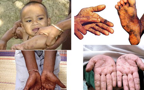 Những hình ảnh đáng sợ khi trẻ bị nhiễm độc chì