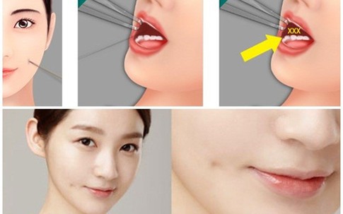 Mặt biến dạng vì phẫu thuật tạo má lúm đồng tiền