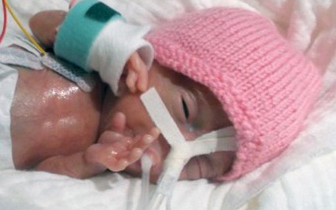 Sự hồi sinh kỳ diệu của em bé chào đời chỉ hơn 200 gram