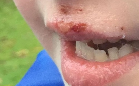 Bé 6 tuổi bị bỏng rộp, chảy máu môi vì cắn vào đèn led