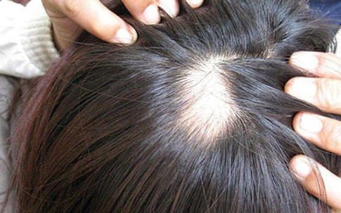 Xài "thần dược" chống hói, lông lá mọc đầy người