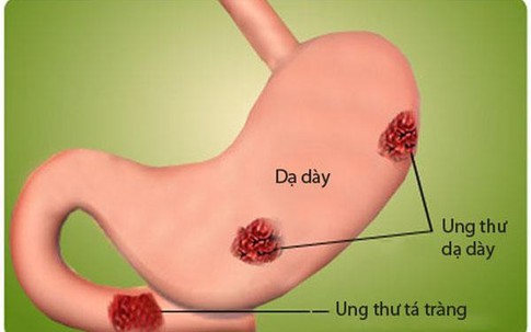 Bệnh nhân ung thư sợ mổ, bỏ đói tế bào, ăn gạo lứt "đuổi" bệnh