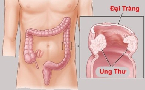 Ung thư trực tràng nguy hiểm thế nào?
