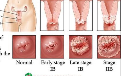 Ung thư cổ tử cung vì mỗi tháng làm việc này 1 lần