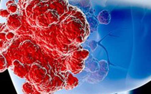 "Thủ phạm" đáng sợ khiến cả nhà 5 người đều chết vì ung thư gan