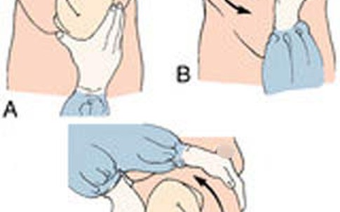 Thủ thuật xoay ngôi thai nhi đẻ ngược