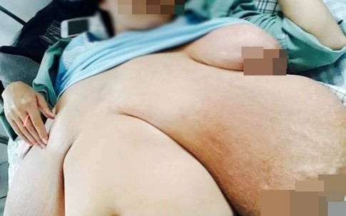 Bộ ngực khổng lồ của người phụ nữ ở Phú Thọ có to lại nếu được phẫu thuật?