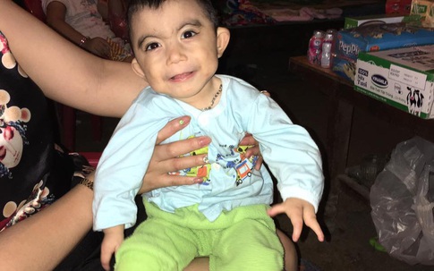 Xót xa em bé 3 tuổi chỉ 6kg với hai bàn tay đều không lành lặn